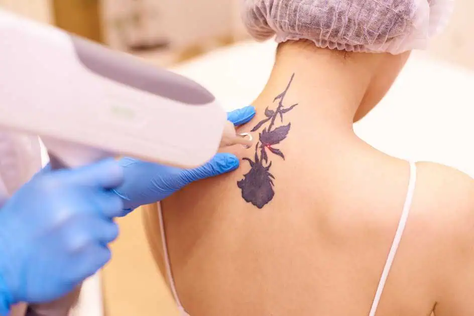 PicoSure® Pro for Tattoo Removal in Geneva, IL by Dermatique Laser and Skin, C Corp