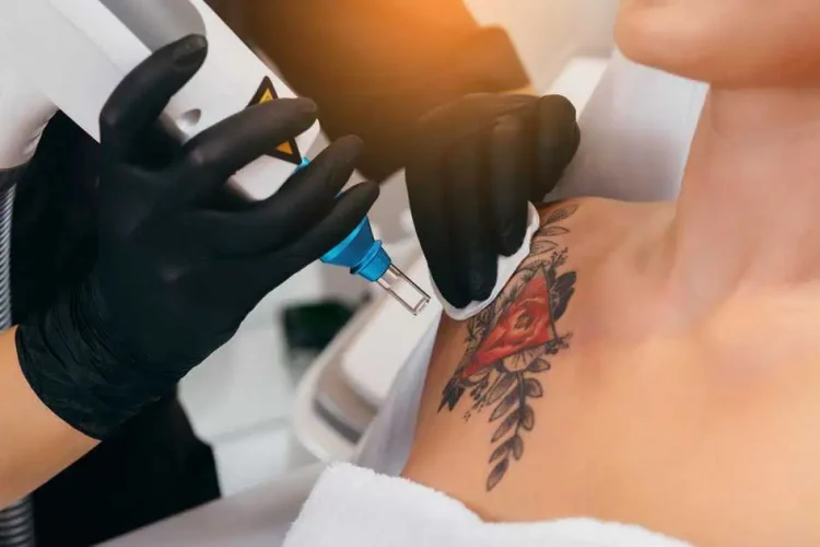 Laser Tattoo Removal in Geneva, IL by Dermatique Laser and Skin